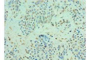 Immunohistochemistry of paraffin-embedded human breast cancer using ABIN7147590 at dilution of 1:100 (CLIC4 antibody  (AA 1-253))