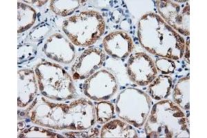Immunohistochemical staining of paraffin-embedded Carcinoma of liver tissue using anti-LIPG mouse monoclonal antibody. (LIPG antibody)
