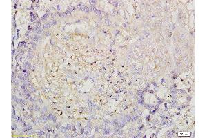 Formalin-fixed and paraffin embedded human esophageal carcinoma labeled with Anti-ROCK1 Polyclonal Antibody, Unconjugated  at 1:200 followed by conjugation to the secondary antibody and DAB staining. (ROCK1 antibody  (AA 1001-1200))