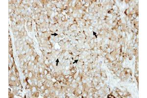 IHC-P Image Immunohistochemical analysis of paraffin-embedded BT474 xenograft, using LAMP2, antibody at 1:500 dilution. (LAMP2 antibody)