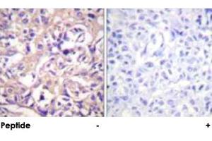 Immunohistochemical analysis of paraffin-embedded human breast carcinoma tissue using TK1 polyclonal antibody . (TK1 antibody  (Ser13))