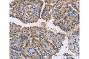 Immunohistochemistry of Human thyroid cancer using NCR1 Polyclonal Antibody at dilution of 1:20