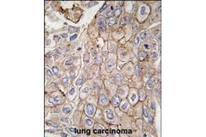 Formalin-fixed and paraffin-embedded human lung carcinoma tissue reacted with CLIC1 antibody, which was peroxidase-conjugated to the secondary antibody, followed by DAB staining. (CLIC1 antibody)