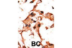 Formalin-fixed and paraffin-embedded human cancer tissue reacted with BIRC3 polyclonal antibody  , which was peroxidase-conjugated to the secondary antibody, followed by DAB staining. (BIRC3 antibody  (N-Term))