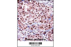 TERF2IP Antibody immunohistochemistry analysis in formalin fixed and paraffin embedded human breast carcinoma followed by peroxidase conjugation of the secondary antibody and DAB staining.