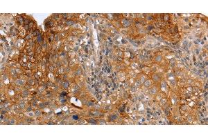 Immunohistochemistry of paraffin-embedded Human cervical cancer using PLAUR Polyclonal Antibody at dilution of 1:60 (PLAUR antibody)