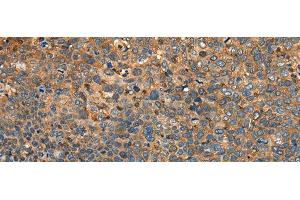 Immunohistochemistry of paraffin-embedded Human cervical cancer tissue using MYL12B Polyclonal Antibody at dilution of 1:25(x200) (MYL12B antibody)