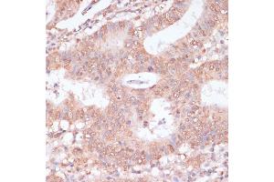 Immunohistochemistry of paraffin-embedded human colon carcinoma using BYSL antibody (ABIN6129546, ABIN6137672, ABIN6137674 and ABIN6215553) at dilution of 1:100 (40x lens). (Bystin-Like antibody  (AA 120-280))