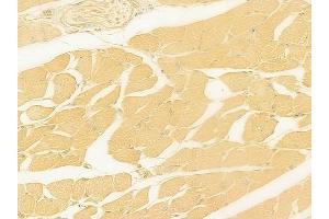 ABIN6262561 and ABIN6278898 at 1/100 staining human tongue carcinoma by IHC-P. (IL28B antibody  (Internal Region))