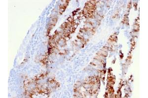 Formalin-fixed, paraffin-embedded human colon carcinoma stained with DR5 Mouse Monoclonal Antibody (DR5/3381). (TNFRSF10B antibody  (AA 266-393))
