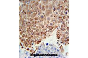 PHGDH Antibody immunohistochemistry analysis in formalin fixed and paraffin embedded human hepatocarcinoma followed by peroxidase conjugation of the secondary antibody and DAB staining. (PHGDH antibody  (AA 249-277))