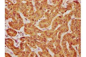 IHC image of ABIN7160120 diluted at 1:1200 and staining in paraffin-embedded human liver cancer performed on a Leica BondTM system. (MOBKL1A antibody  (AA 2-216))
