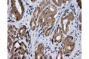 Immunohistochemical staining of paraffin-embedded Adenocarcinoma of ovary tissue using anti-LIPG mouse monoclonal antibody. (LIPG antibody)