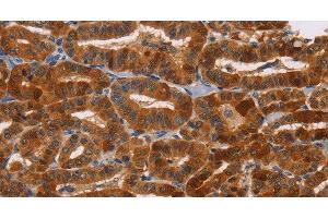 Immunohistochemistry of paraffin-embedded Human thyroid cancer tissue using NCR1 Polyclonal Antibody at dilution 1:30 (NCR1 antibody)