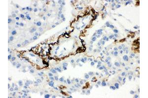 Anti- Vitronectin Picoband antibody, IHC(P) IHC(P): Human Lung Cancer Tissue (Vitronectin antibody  (C-Term))
