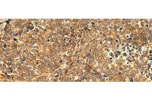 Immunohistochemistry of paraffin-embedded Human lung cancer tissue using ABHD10 Polyclonal Antibody at dilution of 1:50(x200) (ABHD10 antibody)