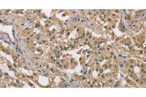 Immunohistochemistry of paraffin-embedded Human thyroid cancer tissue using DACH2 Polyclonal Antibody at dilution 1:40 (DACH2 antibody)