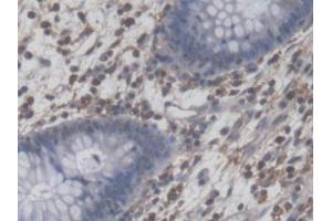DAB staining on IHC-P; Samples: Human Colorectal cancer Tissue (NFIA antibody  (AA 1-143))