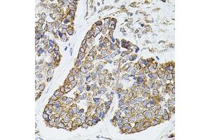 Immunohistochemistry of paraffin-embedded human esophageal cancer using MTTP antibody (ABIN5970876) at dilution of 1/100 (40x lens).