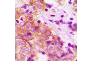 Immunohistochemical analysis of MARK2 staining in human prostate cancer formalin fixed paraffin embedded tissue section.