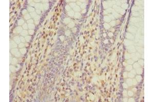 Immunohistochemistry of paraffin-embedded human colon cancer using ABIN7163880 at dilution of 1:100 (GALNT2 antibody  (AA 442-571))