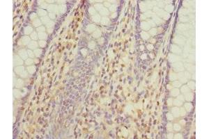 Immunohistochemistry of paraffin-embedded human colon cancer using ABIN7163880 at dilution of 1:100 (GALNT2 antibody  (AA 442-571))