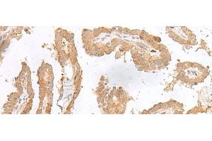 Immunohistochemistry of paraffin-embedded Human thyroid cancer tissue using CXCL6 Polyclonal Antibody at dilution of 1:45(x200) (CXCL6 antibody)