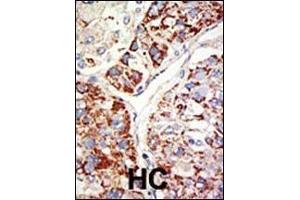 Formalin-fixed and paraffin-embedded human cancer tissue reacted with the primary antibody, which was peroxidase-conjugated to the secondary antibody, followed by DAB staining. (EZH1 antibody  (AA 393-422))