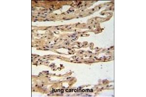 FKBPL Antibody (C-term) (ABIN1881347 and ABIN2840192) IHC analysis in formalin fixed and paraffin embedded lung carcinoma followed by peroxidase conjugation of the secondary antibody and DAB staining. (FKBPL antibody  (C-Term))