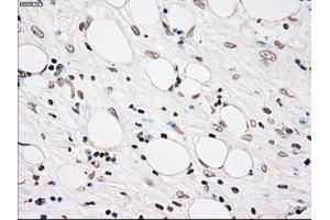 Immunohistochemical staining of paraffin-embedded Carcinoma of kidney tissue using anti-PLK1mouse monoclonal antibody. (PLK1 antibody)