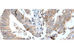 Immunohistochemistry of paraffin-embedded Human colorectal cancer tissue using GKN1 Polyclonal Antibody at dilution of 1:30(x200) (Gastrokine 1 antibody)