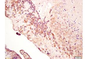 Formalin-fixed and paraffin embedded human lung carcinoma labeled with Anti-Calreticulin Polyclonal Antibody, Unconjugated (ABIN759731) at 1:200 followed by conjugation to the secondary antibody and DAB staining (Calreticulin antibody  (AA 101-200))