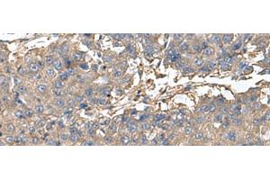 Immunohistochemistry of paraffin-embedded Human liver cancer tissue using BLOC1S6 Polyclonal Antibody at dilution of 1:95(x200) (Pallidin antibody)
