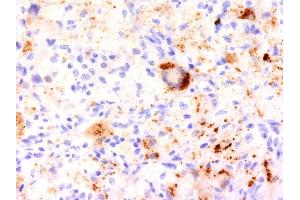 Formalin-fixed, paraffin-embedded human Erdheim-Chester disease (also known as polyostotic sclerosing histiocytosis) stained with TNF alpha Monoclonal Antibody (TNF706). (TNF alpha antibody  (N-Term))