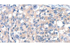 Immunohistochemistry of paraffin-embedded Human breast cancer tissue using GRIN2D Polyclonal Antibody at dilution 1:30