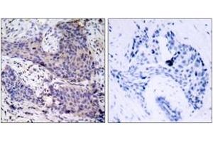 Immunohistochemistry analysis of paraffin-embedded human breast carcinoma tissue, using BAD (Ab-136) Antibody. (BAD antibody  (AA 102-151))