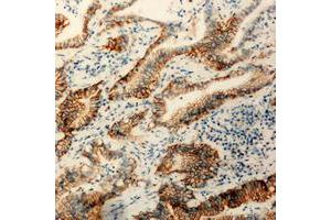 Immunohistochemical analysis of Claudin 3 staining in human colon cancer formalin fixed paraffin embedded tissue section.