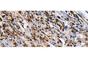 Immunohistochemistry of paraffin-embedded Human gastric cancer tissue using SAV1 Polyclonal Antibody at dilution of 1:90(x200)