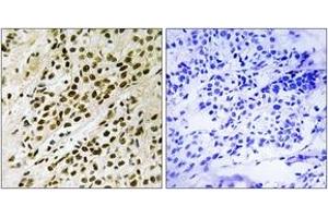 Immunohistochemistry analysis of paraffin-embedded human breast carcinoma, using MAPKAPK5 (Phospho-Thr182) Antibody. (MAPKAP Kinase 5 antibody  (pThr182))