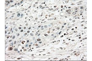 Immunohistochemical staining of paraffin-embedded Carcinoma of pancreas tissue using anti-TYRO3mouse monoclonal antibody. (TYRO3 antibody)