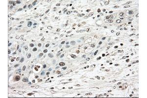 Immunohistochemical staining of paraffin-embedded Carcinoma of pancreas tissue using anti-TYRO3mouse monoclonal antibody.
