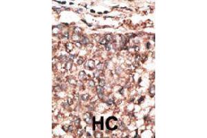 Immunohistochemical staining (Formalin-fixed paraffin-embedded sections) of human hepatocarcinoma. (PDGFD antibody  (AA 313-341))