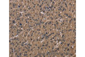 Immunohistochemistry of Human liver cancer using FGF7 Polyclonal Antibody at dilution of 1:30