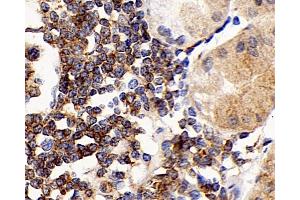 Immunohistochemistry analysis of paraffin-embedded human stomach cancer using CD192 Polyclonal Antibody at dilution of 1:300. (CCR2 antibody)