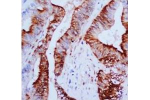 Immunohistochemical analysis of paraffin embedded Mammary cancer sections, staining MAPK1-3 in cytoplasm and nucleus, DAB chromogenic reaction (ERK1/2 antibody  (N-Term))