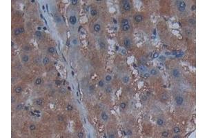 Detection of Cys-C in Human Liver cancer Tissue using Polyclonal Antibody to Cystatin C (Cys-C) (CST3 antibody  (AA 27-146))