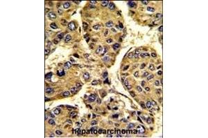 Formalin-fixed and paraffin-embedded human hepatocarcinoma with ASPN Antibody (Center), which was peroxidase-conjugated to the secondary antibody, followed by DAB staining. (Asporin antibody  (AA 242-269))