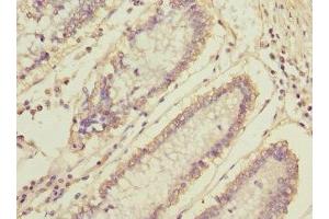 Immunohistochemistry of paraffin-embedded human colon cancer using ABIN7160476 at dilution of 1:100 (MLF1 antibody  (AA 1-268))