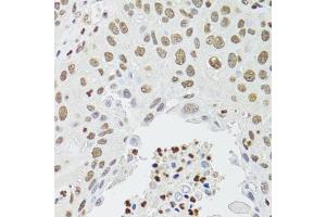 Immunohistochemistry of paraffin-embedded human lung cancer using CDX2 antibody (ABIN1871774) at dilution of 1:100 (40x lens). (CDX2 antibody)