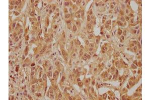 IHC image of ABIN7175710 diluted at 1:300 and staining in paraffin-embedded human liver cancer performed on a Leica BondTM system. (MORG1 antibody  (AA 64-315))